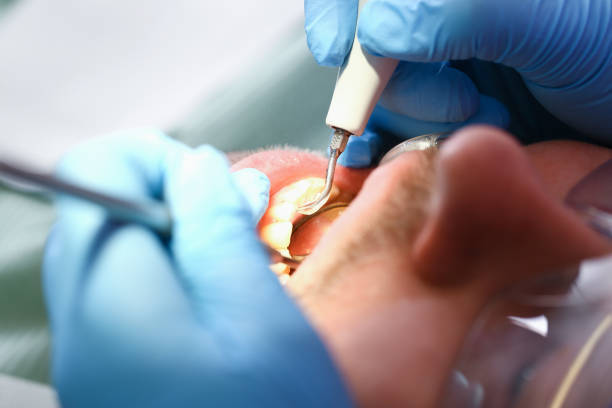 Best Dentist for Tooth Abscess  in College Park, MD